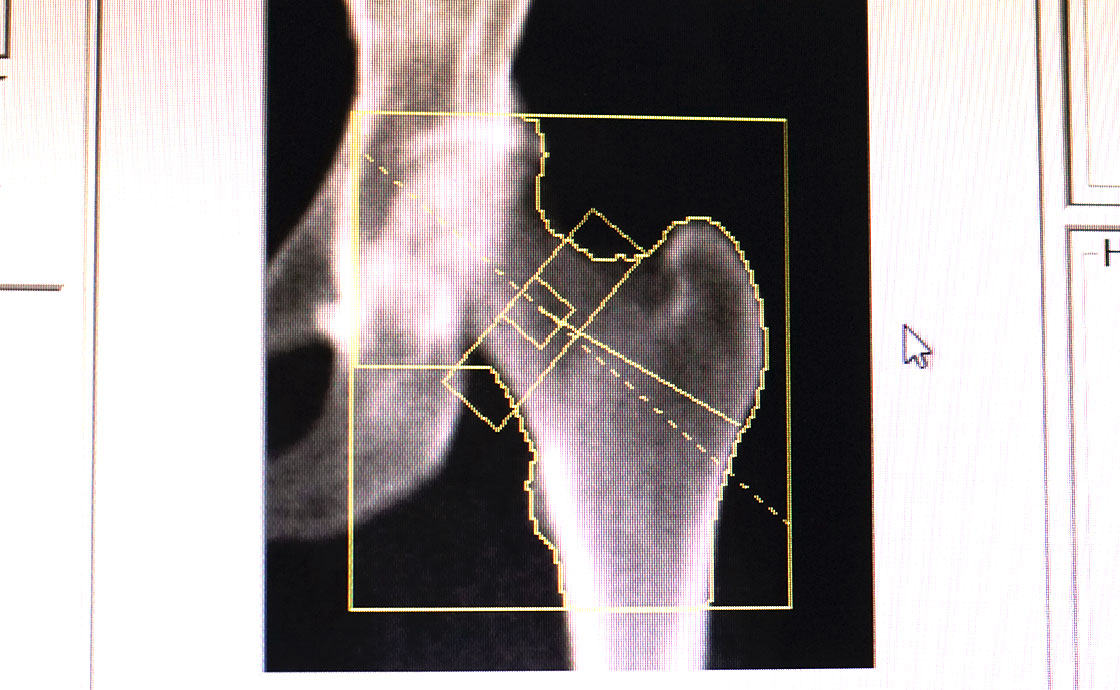 osteoporosis-scanning-explained-nuffield-health