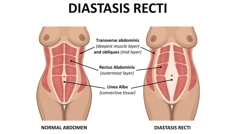 Diastasis Recti – Bridging the Gap