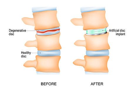 Lumbar artificial disc replacement diagram - before and after