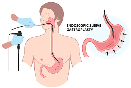 Endoscopic sleeve gastroplasty